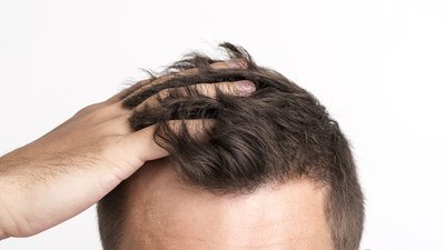 Trapianto di capelli, quanto costa: dove si risparmia