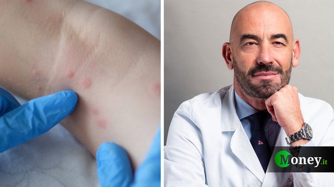 Vaiolo delle scimmie: «Ecco i sintomi per riconoscerlo e cosa fare subito». Intervista al prof. Bassetti
