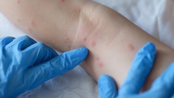 Vaiolo delle scimmie, acquistate 110mila dosi di vaccino. Ecco chi dovrà farlo