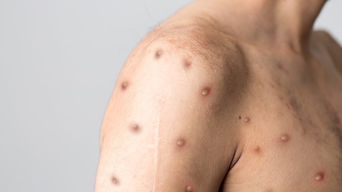 Cos'è il vaiolo delle scimmie? Sintomi, trasmissione e vaccino: dobbiamo avere paura?