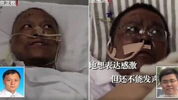 Cinesi guariti dal virus si risvegliano con la pelle scura: la spiegazione dei medici