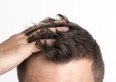  I costi del trapianto di capelli in Italia e nel mondo