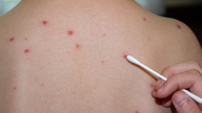 Morbillo, nuova variante in Italia: sintomi e perché è pericolosa