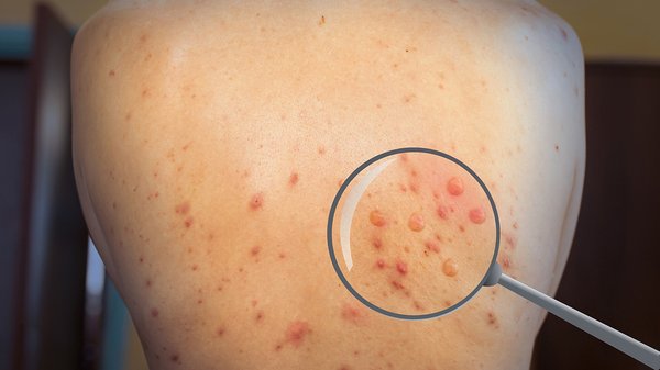 Vaiolo delle scimmie, dichiarata l’emergenza sanitaria globale. Cosa succede ora?