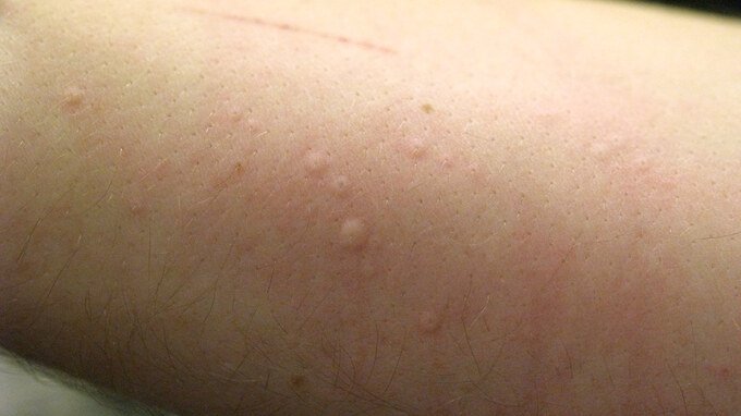 Coronavirus, i segni sulla pelle a cui fare attenzione