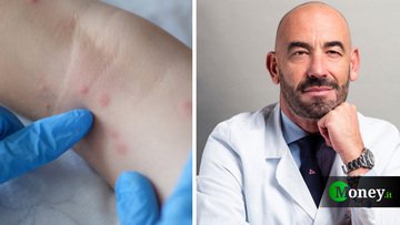 Vaiolo delle scimmie: «Ecco i sintomi per riconoscerlo e cosa fare subito». Intervista al prof. Bassetti