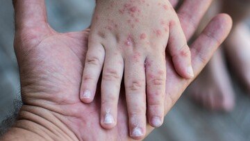 Vaiolo delle scimmie, allarme Oms. Aumenta il livello di allerta?