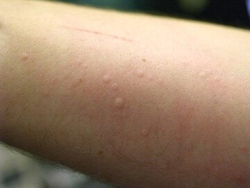 Coronavirus, i segni sulla pelle a cui fare attenzione