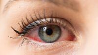 Un sintomo agli occhi può svelare chi ha la Long Covid: ecco qual è