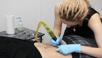 Rimozione del tatuaggio, quanto costa: tempi e tariffe