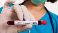 Coronavirus, i ricercatori: rischio sviluppo patologia grave per gli under 21