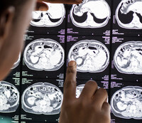Coronavirus, allarme danni al cervello: spuntano sintomi mai visti prima