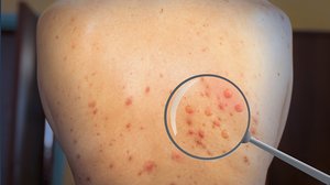 Vaiolo delle scimmie, boom di contagi nell'ultima settimana: ora l'Oms può dichiarare l'emergenza sanitaria