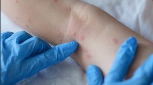 Primo caso di vaiolo delle scimmie in Italia: l'Iss istituisce una task force. Ecco come sta il «paziente zero»