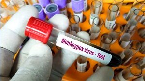 “Invitiamo i cittadini a mantenere la calma”, la Sierra Leone dichiara l'emergenza sanitaria contro il vaiolo