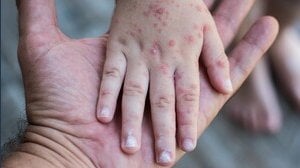 Vaiolo delle scimmie, allarme Oms. Aumenta il livello di allerta?