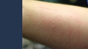 Coronavirus, i segni sulla pelle a cui fare attenzione