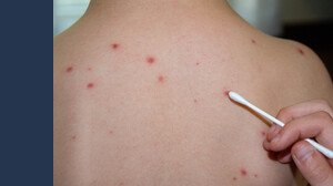 Morbillo, boom di casi in Italia tra bambini, sintomi e come riconoscerlo