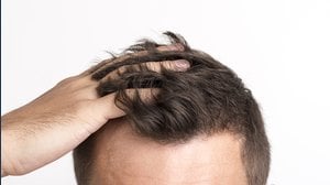 I costi del trapianto di capelli in Italia e nel mondo