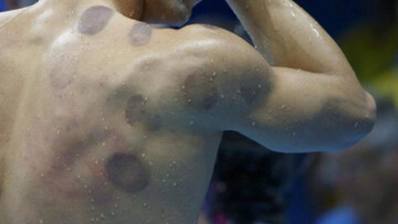 Sai cosa sono i segni circolari sulla schiena dei nuotatori?