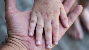 Vaiolo delle scimmie, allarme Oms. Aumenta il livello di allerta?