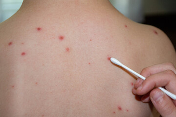 Una epidemia di morbillo è inevitabile: la profezia di Bassetti