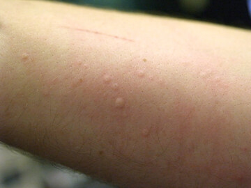 Coronavirus, i segni sulla pelle a cui fare attenzione