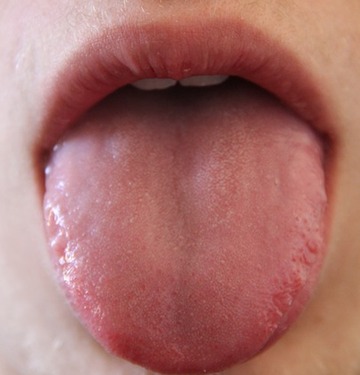 Lingua Covid: lo strano nuovo sintomo. A cosa fare attenzione